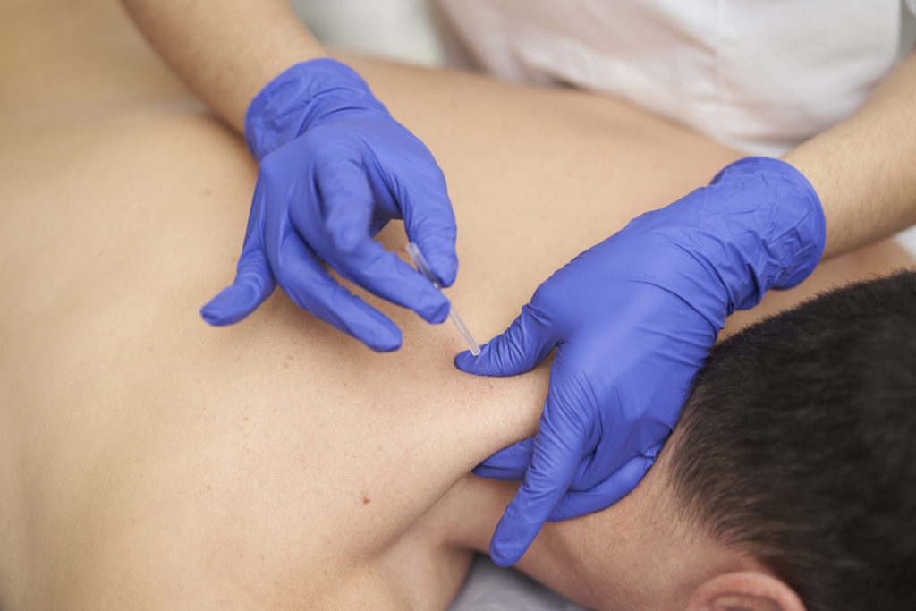 physiotherapist treating an overload with dry needling